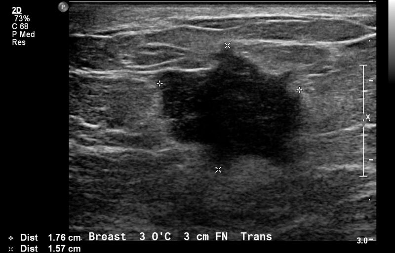 File:Breast cancer and multiple circumscribed masses (Radiopaedia 62456-70700 A 2).jpeg