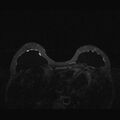 Breast implants - MRI (Radiopaedia 26864-27035 T2 SPAIR 18).jpg