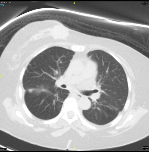 File:Breast primary with lung and bone metastases (Radiopaedia 40620-43228 Axial lung window 23).jpg