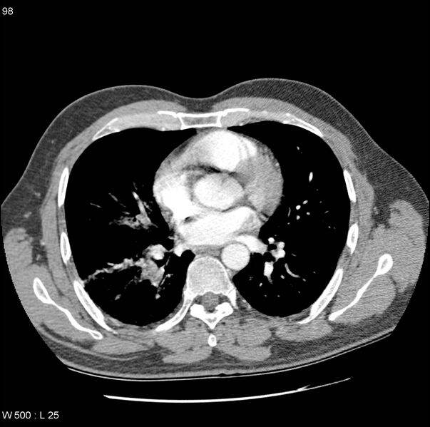 File:Bronchial arterial aneurysm (Radiopaedia 22293-22330 A 3).jpg