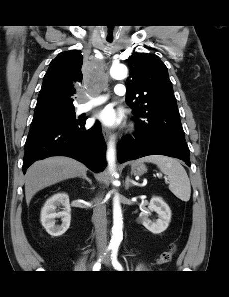 File:Bronchial carcinoma (Radiopaedia 18285-18112 A 4).jpg