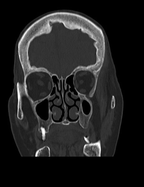 File:Burnt-out meningioma (Radiopaedia 51557-57337 Coronal bone window 11).jpg