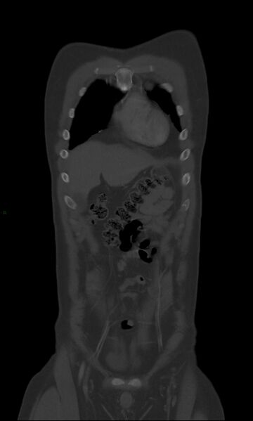File:Burst fracture (Radiopaedia 83168-97542 Coronal bone window 17).jpg