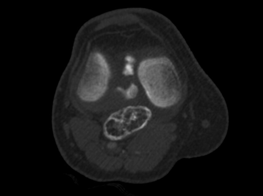 Calcified hematoma - popliteal fossa (Radiopaedia 63938-72763 C 19).jpg