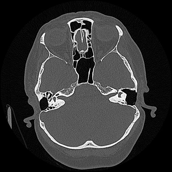 File:Canal up mastoidectomy (Radiopaedia 78108-90638 Axial bone window 81).jpg