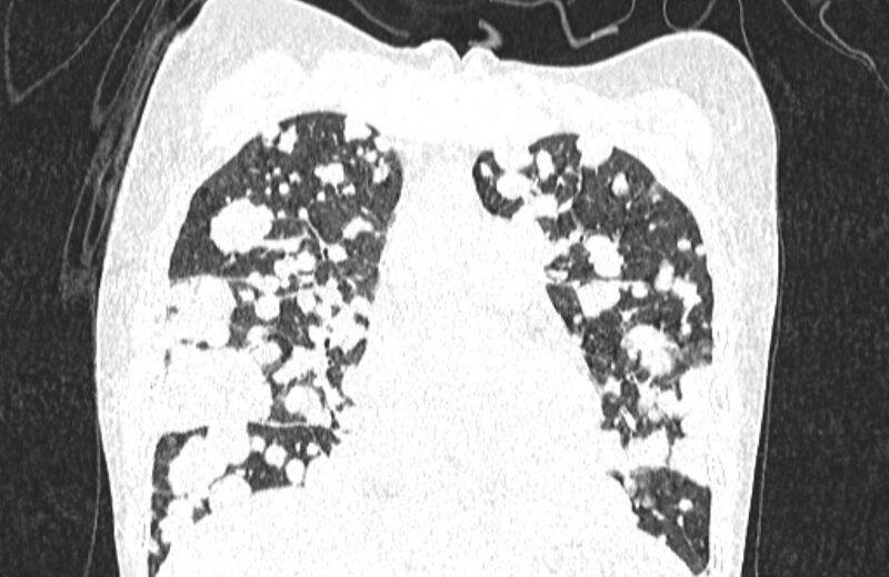 File:Cannonball metastases from breast cancer (Radiopaedia 91024-108569 Coronal lung window 53).jpg