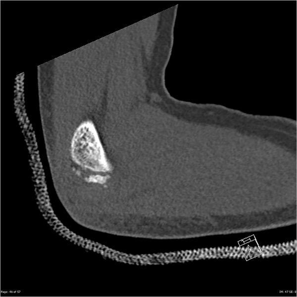 File:Capitellum fracture (Radiopaedia 23352-23426 Sagittal bone window 46).jpg