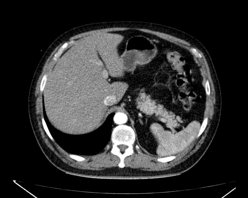 Carcinoid tumor with hepatic metastases (Radiopaedia 22651-22670 B 20).jpg