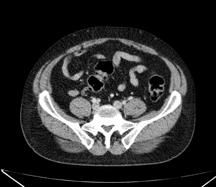 File:Carcinoid tumor with hepatic metastases (Radiopaedia 22651-22670 C 63).jpg