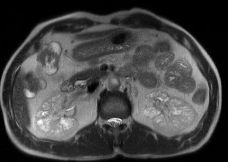 File:Caroli disease with medullary sponge kidney and nephrocalcinosis (Radiopaedia 10805-11251 B 1).jpg