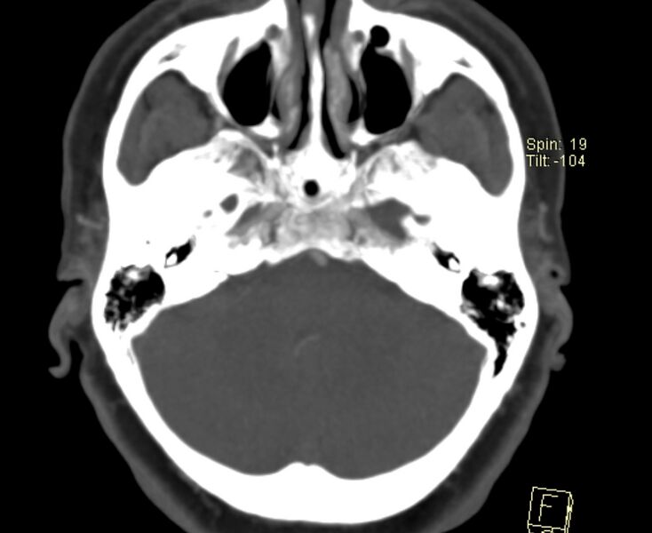 File:Caroticocavernous fistula (Radiopaedia 29565-30069 Axial MIP 6).jpg