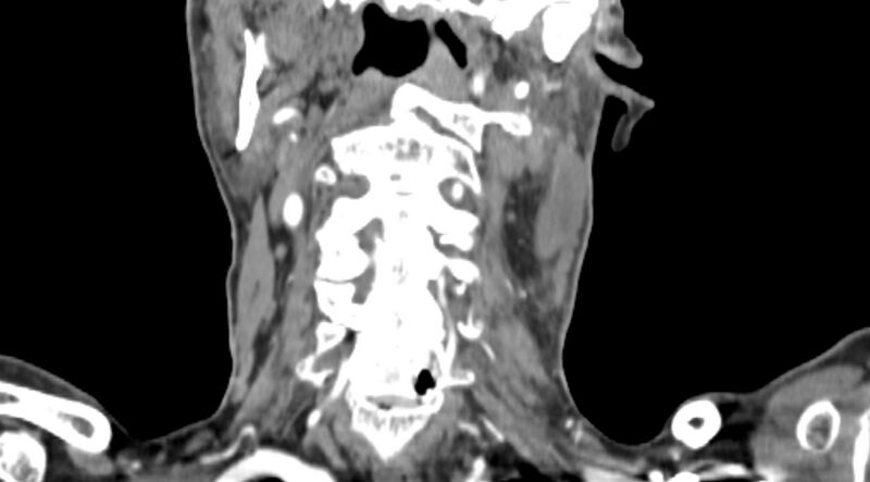 File:Carotid artery pseudoaneurysm (Radiopaedia 84030-99259 D 58).jpg