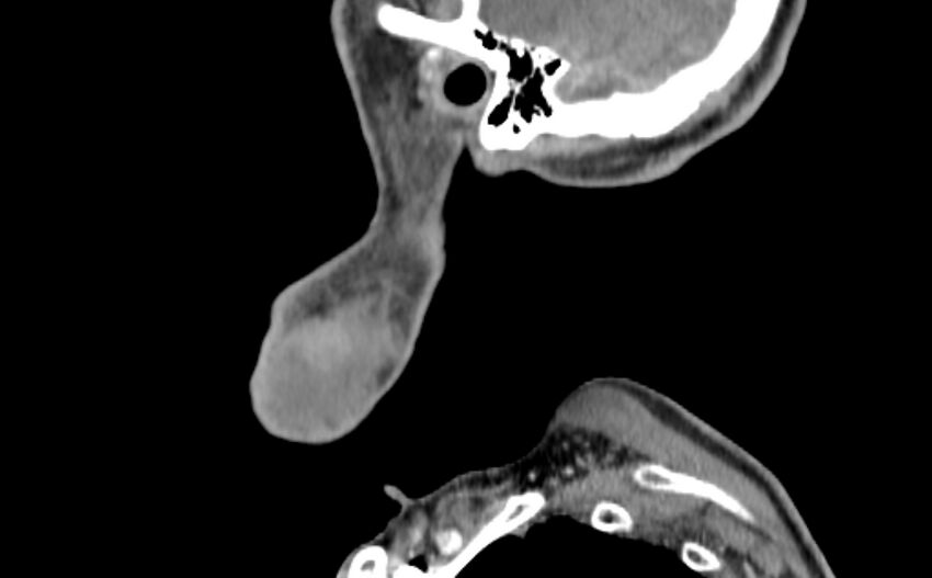 Carotid artery pseudoaneurysm (Radiopaedia 84030-99259 E 63).jpg