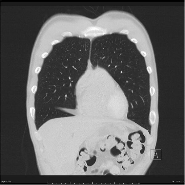 File:Cavitating lung cancer (Radiopaedia 25796-25945 lung window 8).jpg