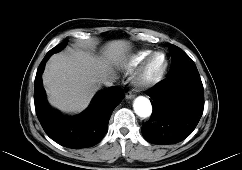 File:Celiac artery aneurysm (Radiopaedia 19121).jpg