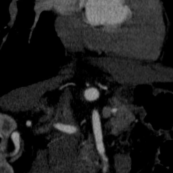 File:Celiac artery aneurysm (Radiopaedia 21574-21525 B 13).JPEG