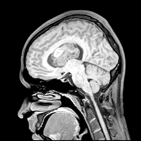 File:Central neurocytoma (Radiopaedia 79320-92380 Sagittal T1 142).jpg