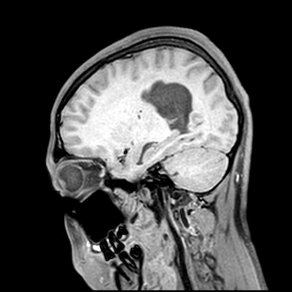 File:Central neurocytoma (Radiopaedia 79320-92380 Sagittal T1 177).jpg