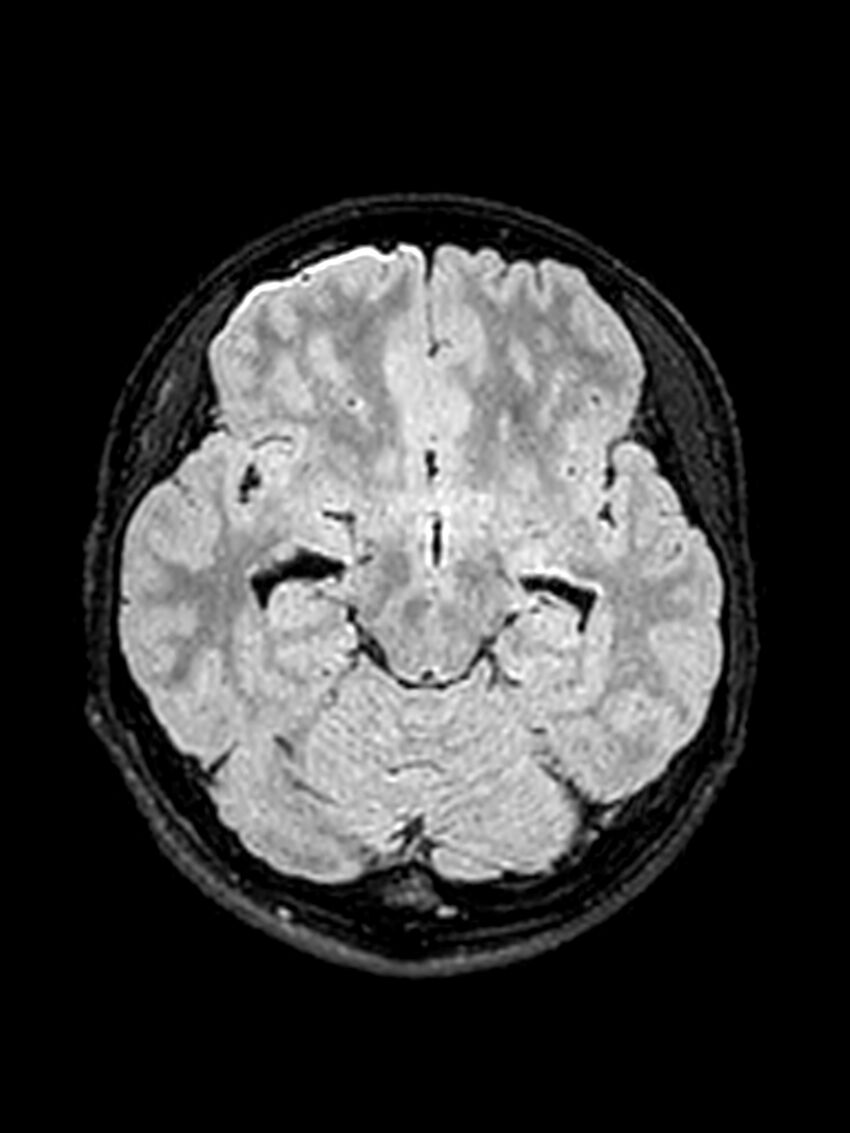 Central neurocytoma (Radiopaedia 79320-92381 Axial FLAIR 104).jpg