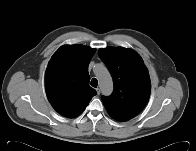 File:Centrilobular pulmonary emphysema (Radiopaedia 26808-26971 Axial non-contrast 11).jpg