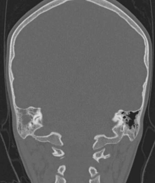 File:Cerebellar abscess (Radiopaedia 73727-84527 Coronal bone window 39).jpg