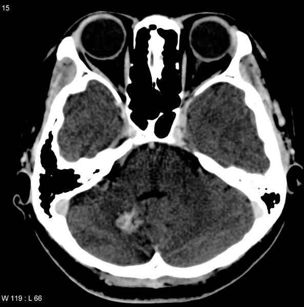 File:Cerebellar arteriovenous malformation (Radiopaedia 5220-36607 A 3).jpg