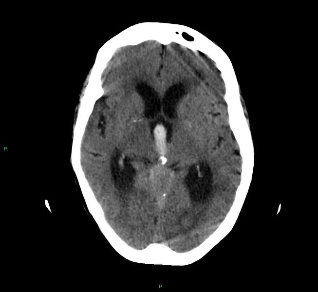 File:Cerebellar hemorrhage (Radiopaedia 58792-66026 Axial non-contrast 28).jpg