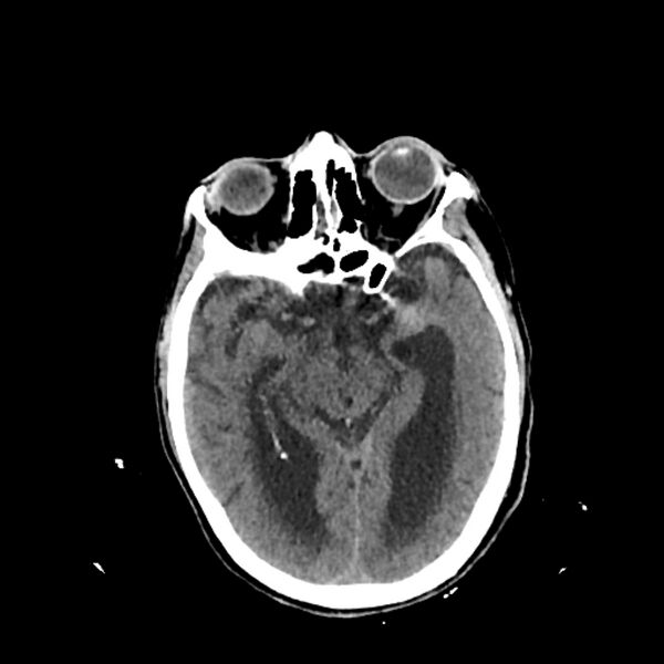 File:Cerebellar metastasis - lung tumor (Radiopaedia 69317-79145 Axial non-contrast 15).jpg