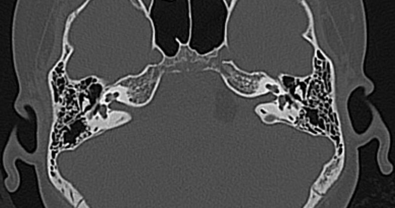 File:Cerebellopontine angle lipoma (Radiopaedia 57303-64242 Axial bone window 29).jpg