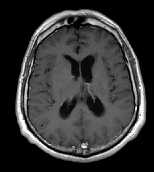 File:Cerebellopontine angle meningioma (Radiopaedia 24459-24764 Axial T1 C+ 15).jpg