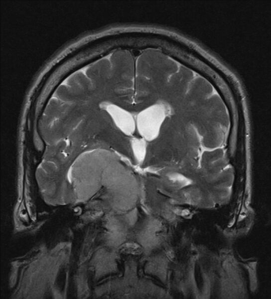 File:Cerebellopontine angle meningioma (Radiopaedia 24459-24764 Coronal T2 11).jpg
