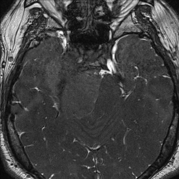 File:Cerebellopontine angle meningioma (Radiopaedia 24459-24764 I 30).jpg