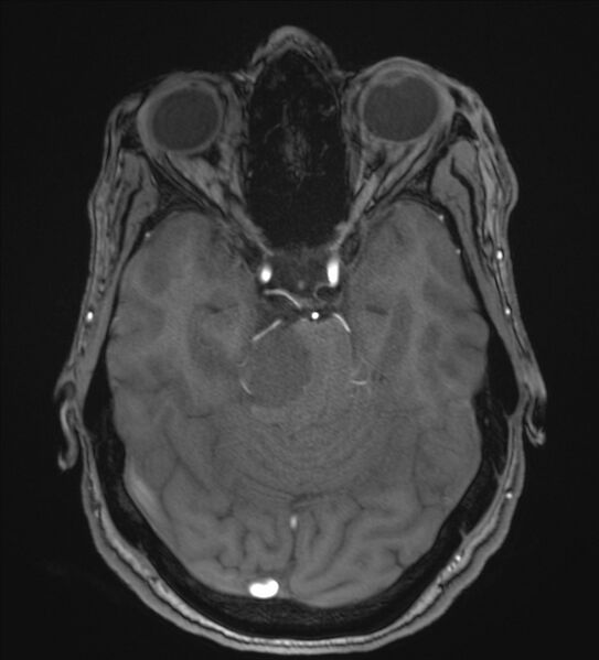 File:Cerebellopontine angle meningioma (Radiopaedia 72983-83680 Axial MRA 42).jpg