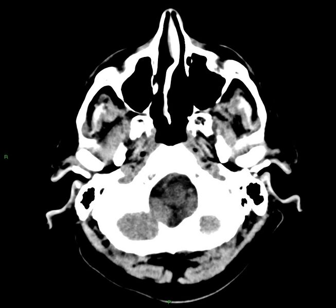 File:Cerebral amyloid angiopathy-associated lobar intracerebral hemorrhage (Radiopaedia 58376-65511 Axial non-contrast 49).jpg