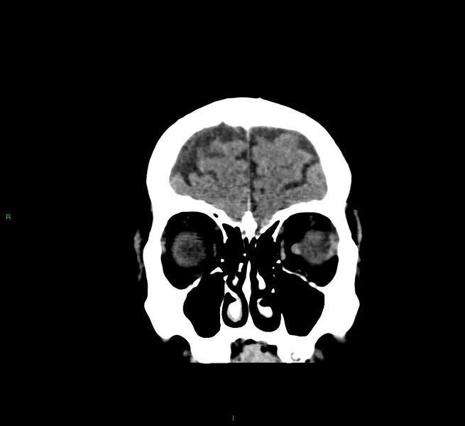 File:Cerebral amyloid angiopathy-associated lobar intracerebral hemorrhage (Radiopaedia 58376-65511 Coronal non-contrast 55).jpg