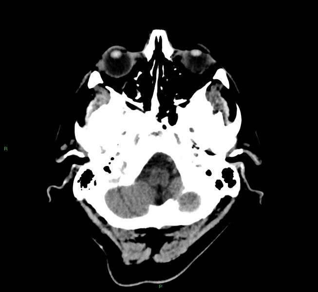 File:Cerebral amyloid angiopathy-associated lobar intracerebral hemorrhage (Radiopaedia 58376-65513 Axial non-contrast 44).jpg