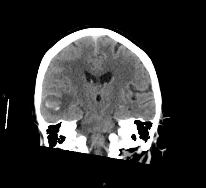 File:Cerebral amyloid angiopathy-associated lobar intracerebral hemorrhage (Radiopaedia 58378-65516 Coronal non-contrast 30).jpg