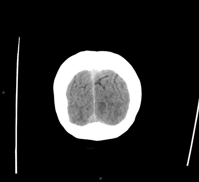 File:Cerebral amyloid angiopathy-associated lobar intracerebral hemorrhage (Radiopaedia 58378-65516 Coronal non-contrast 8).jpg