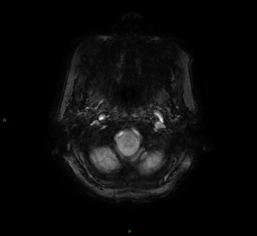 Cerebral amyloid angiopathy-associated lobar intracerebral hemorrhage (Radiopaedia 58378-65517 Axial SWI 6).jpg