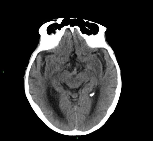 File:Cerebral amyloid angiopathy-associated lobar intracerebral hemorrhage (Radiopaedia 58530-65688 Axial non-contrast 30).jpg
