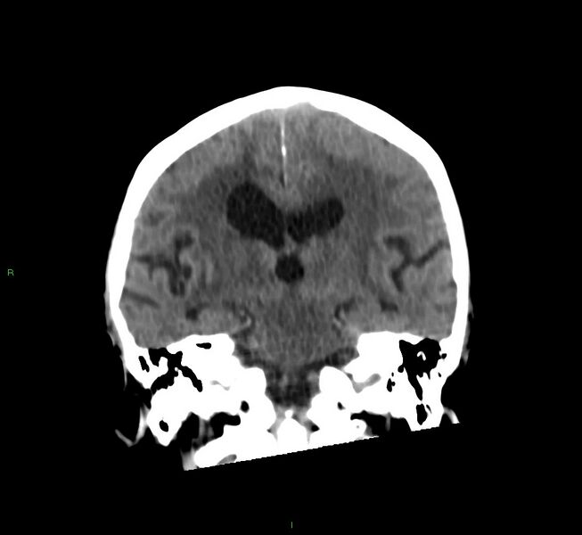 File:Cerebral amyloid angiopathy-associated lobar intracerebral hemorrhage (Radiopaedia 58530-65688 Coronal non-contrast 33).jpg