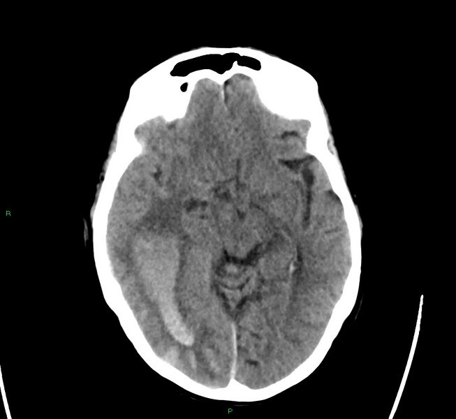 File:Cerebral amyloid angiopathy-associated lobar intracerebral hemorrhage (Radiopaedia 58563-65727 Axial non-contrast 33).jpg