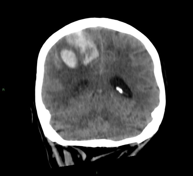 File:Cerebral amyloid angiopathy-associated lobar intracerebral hemorrhage (Radiopaedia 58566-65730 Coronal non-contrast 26).jpg