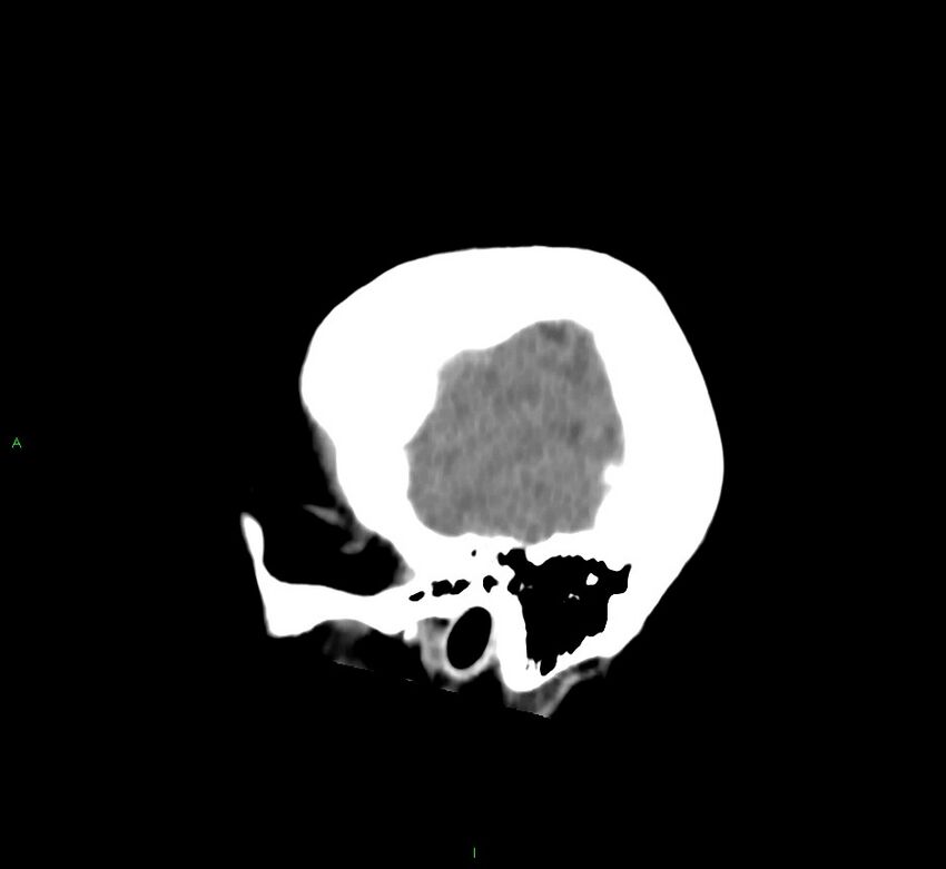 Cerebral amyloid angiopathy-associated lobar intracerebral hemorrhage (Radiopaedia 58752-65973 C 47).jpg