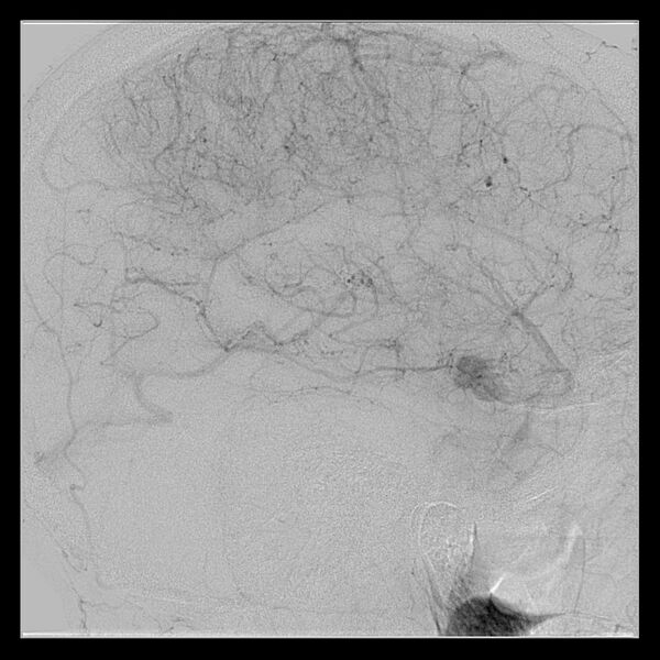 File:Cerebral aneurysm with rupture (Radiopaedia 29933-30458 LT CCA IC 45).jpg