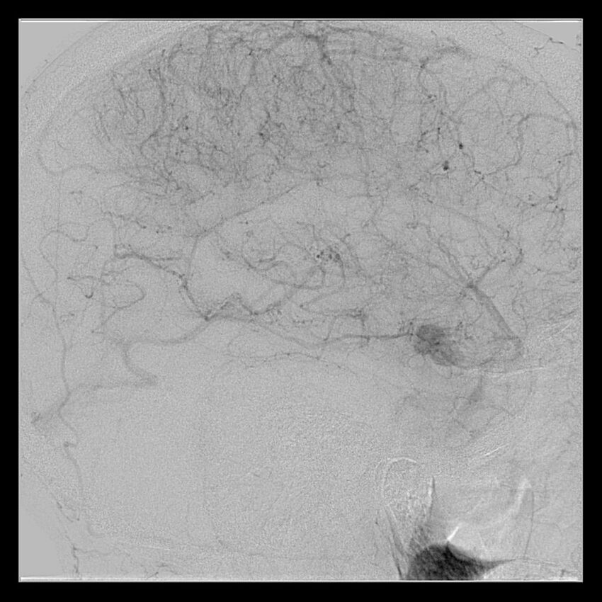 Cerebral aneurysm with rupture (Radiopaedia 29933-30458 LT CCA IC 45).jpg