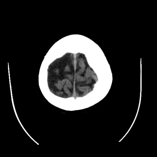 File:Cerebral arteriovenous malformation (Radiopaedia 43729-47189 Axial non-contrast 40).jpg