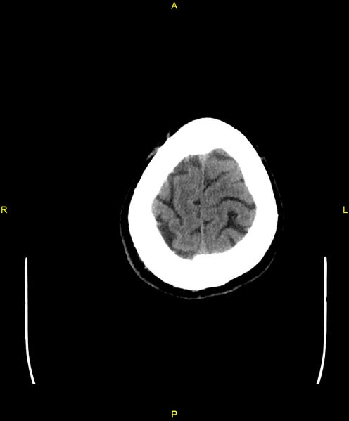 File:Cerebral autosomal dominant arteriopathy with subcortical infarcts and leukoencephalopathy (CADASIL) (Radiopaedia 86108-102051 Axial non-contrast 105).jpg