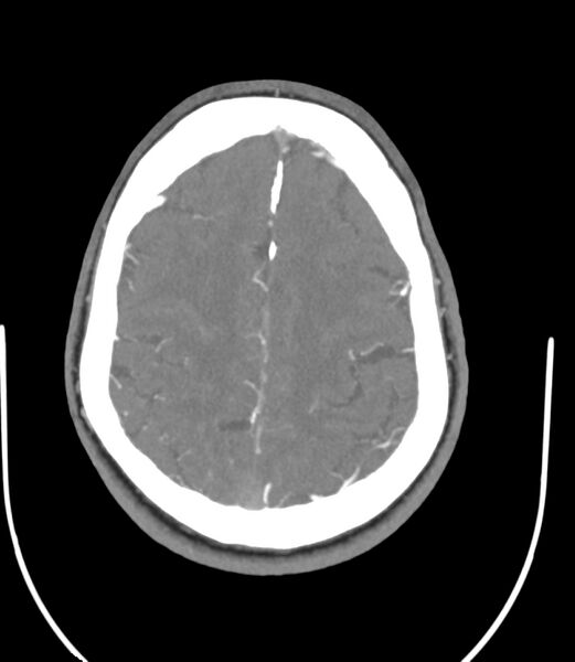 File:Cerebral dural venous sinus thrombosis (Radiopaedia 86514-102576 A 75).jpg