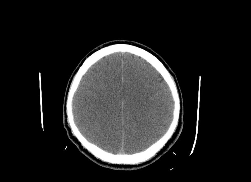File:Cerebral edema (Radiopaedia 82519-96661 Axial non-contrast 17).jpg